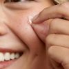 Avarelle Parches para espinillas (40 unidades) Parches hidrocoloides para acné, tratamiento para manchas de acné para imperfecciones y espinillas con aceite de árbol de té, aceite de caléndula y aceite de cica para rostro, vegano, certificado libre de crueldad (40 PARCHES) - Imagen 2