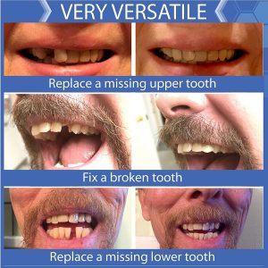 Kit De Repuesto De Dientes Temporales Multitonos Con Caja De