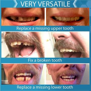 Instant Smile Complete Your Smile – Kit De Repuesto Temporal